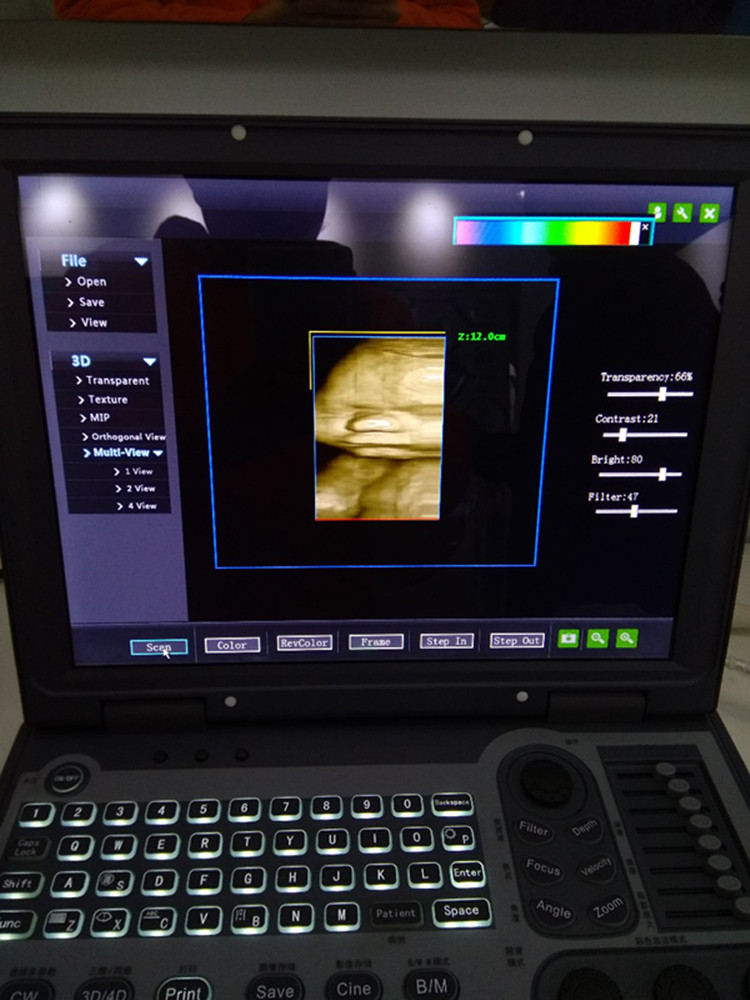 4D Colour Doppler Ultrasound 